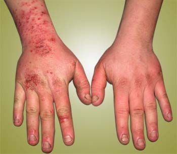 Eczema Risk Factors 